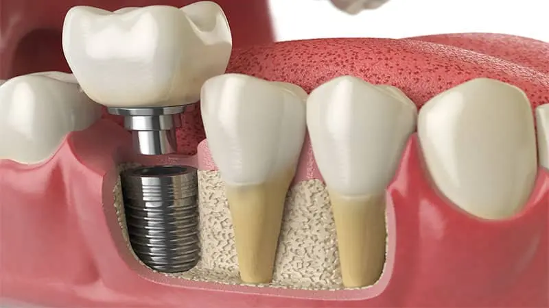Implants dentaires titane Casablanca