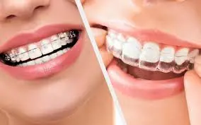 Orthodontie bagues et gouttières Casablanca